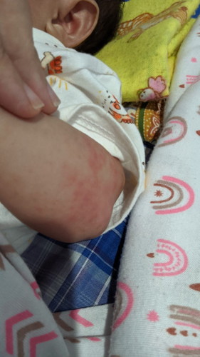 kemerahan pada bayi