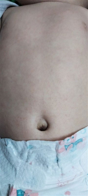 Bintik2 merah kecil di badan