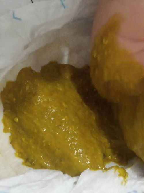 normal o hindi??
nagtatae po ba si baby?