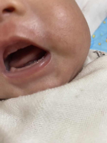 Các mẹ cho e hỏi đẻ ra bé nhà e lợi đã bị hơi hở như kia liệu sau k biết có ảnh hưởng về vấn gì k ạ