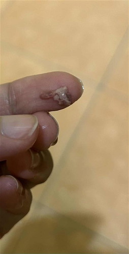 Keluar ketulan semasa kencing