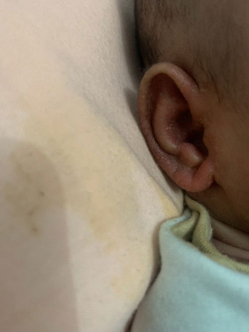 Daun telinga berair dan mengerak