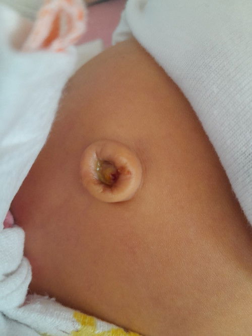สะดือลูกพึ่งจะหลุด