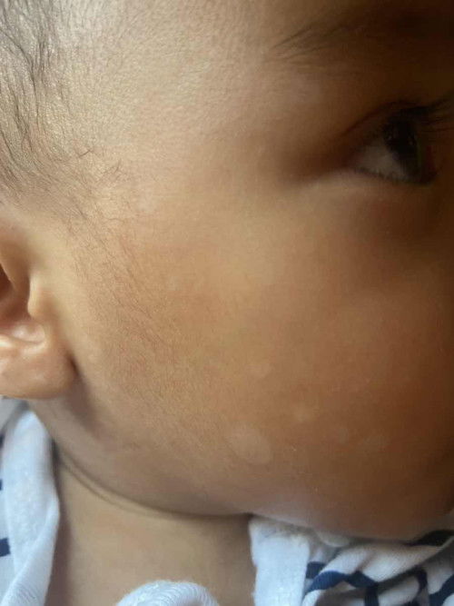 Putih putih di wajah