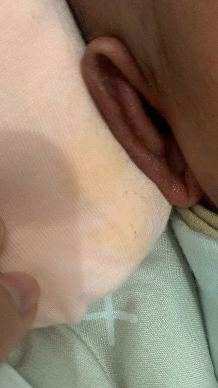 Daun telingan berair dan mengerak