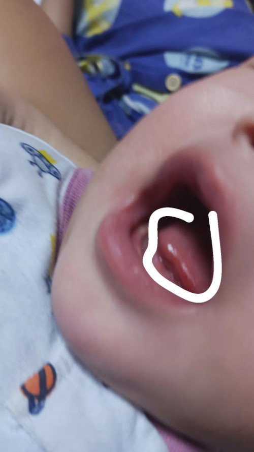 Mga mi napano kaya itong dila ng baby ko? namumula ung dulo na parang nakagat?