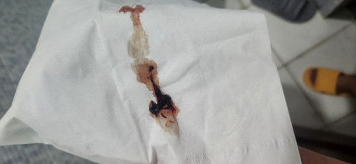 Nagising ako today mga mommy na may prang natuyuang laway sa lips ko pero pag wipe ko blood sya.