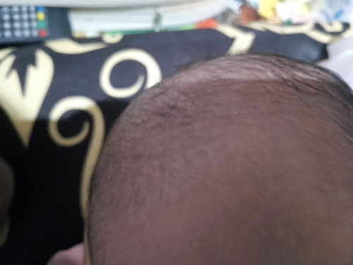 Bintik putih pada bagian kepala baby