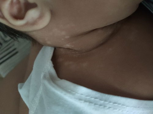 May puti puti sa leeg ni baby