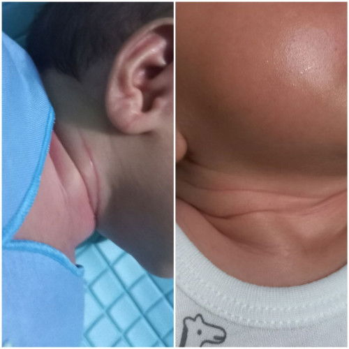 Tips Cara menghilangkan merah2 di kulit bayi