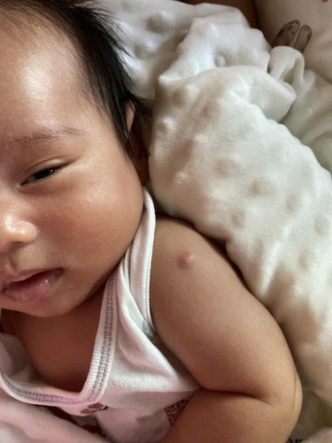 สงสัยค่ะ รอยแดงที่ต้นแขน