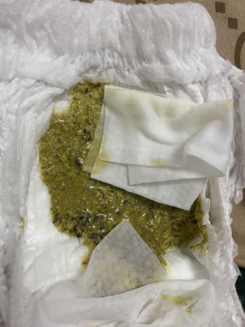 ลูกอึแบบนี้ผิดปกติไหมคะ