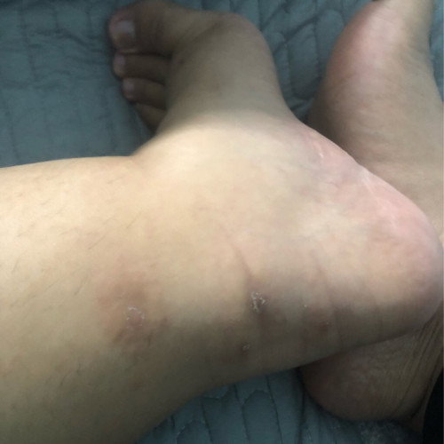 Gatal-gatal whole body