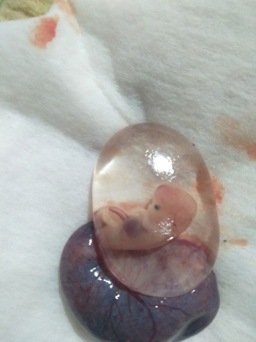 Gagal lagi di kehamilan ke dua