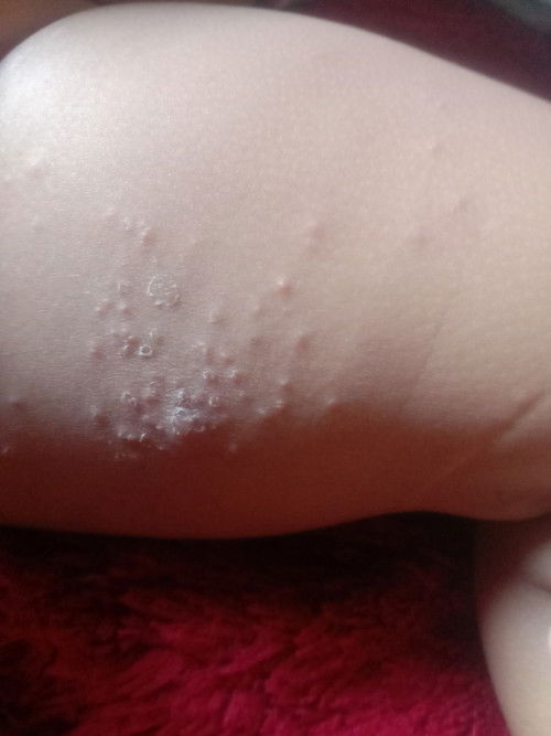 Bun nanya dong kira2 knp ya ini kulit ank ku ada bentol2 di paha nya wktu itu cmn sedikt ini mlh byk