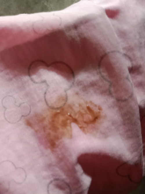 ตกขาวขณะตั้งครรภ์