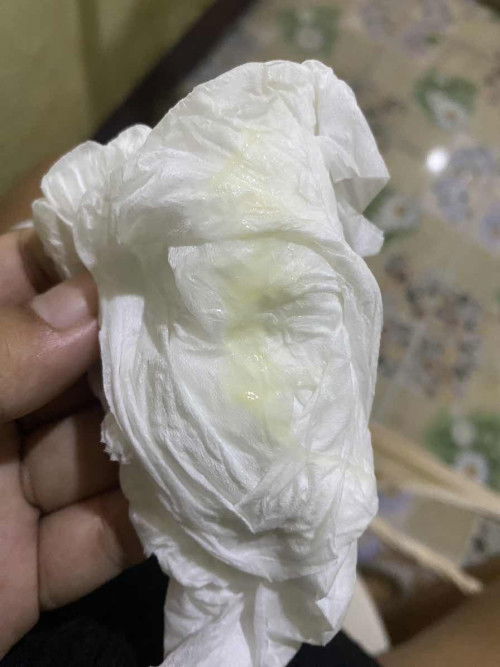 ปกติตกขาวจะเป็นก้อนๆ