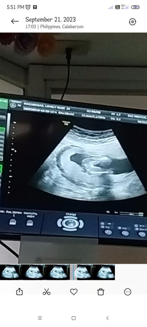 girl po sya sa ultz. Nakabuka po sya nun ultz ko kaso may nagsasabi pwede ba mabago since early pa.