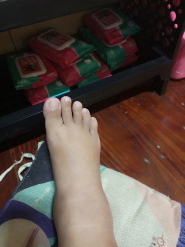 มือชาเท้าบวม38วีค
