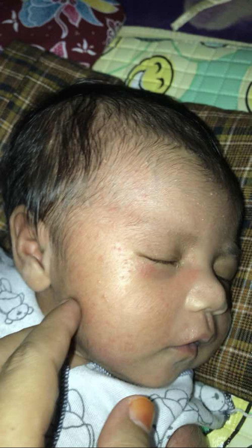 Bintik merah pada bayi 2 minggu