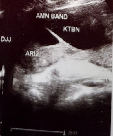 Amniotic band