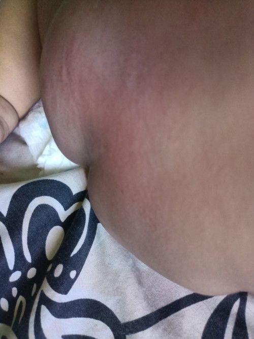 Gatal di bagian bokong, lipatan tangan dan leher