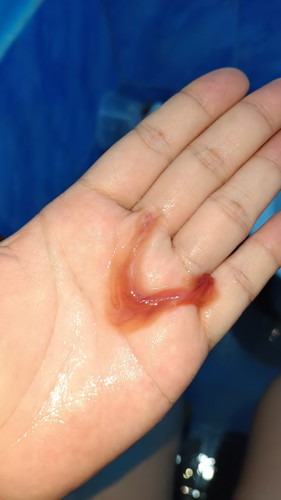 Is this mucus plug? Been admitted due to pre-term labor, kaka discharge lang po nung Wednesday.