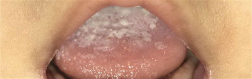 Bercak putih2 dilidah baby 9bulan