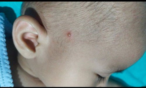 Ini bisul atau apa ya bund