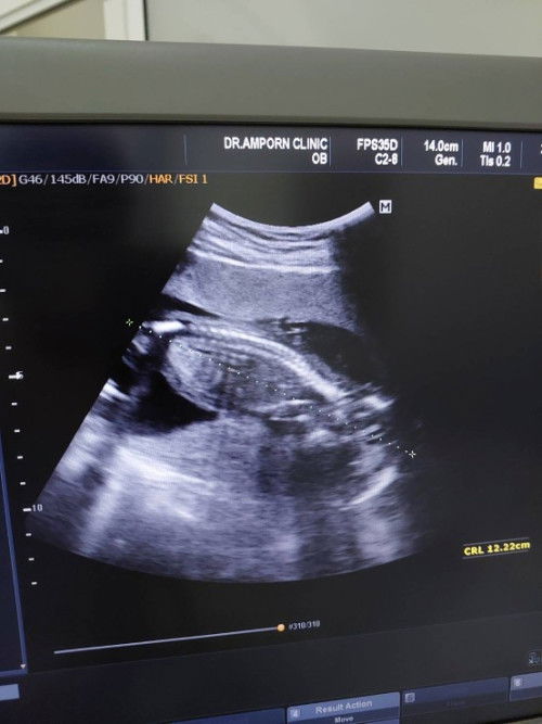 เวลาซาวด์
แม่ๆคนไหนเคยเจอลูกอยู่ท่านี้บ้างคะ