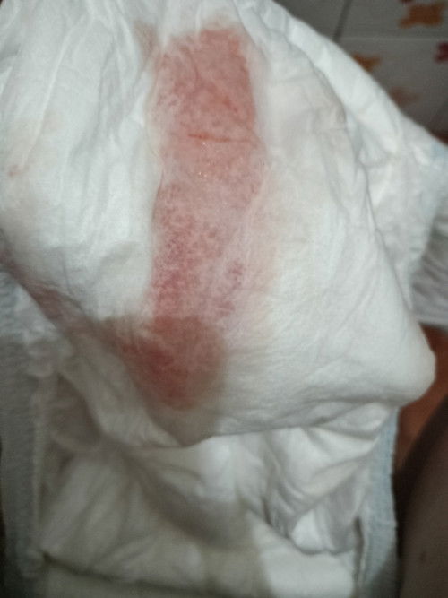 แม่ท้อง  35week มีเลือดออกแบบนี้คืออะไรคะ แต่ไม่ปวดท้อง มีแค่เวลานอนพลิกตัวเจ็บหน่วงท้องน้อยด้ายซ้าย