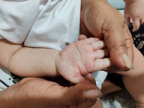 Hello mga mommies, ask ko lang kung bakit kaya nagkaganito palad ng baby ko mapula😥