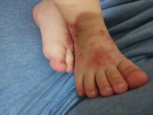 Ruam atau penyakit mulut, kaki dan tangan