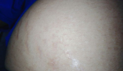 Cara menghilangkan Stretch Mark