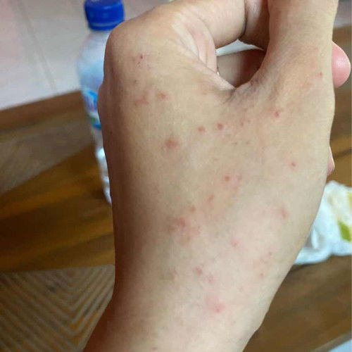 Gatel2 seluruh badan