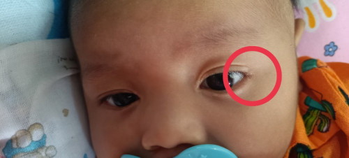 ลูก 3 เดือน เปลือกตา มีรอยขาวๆ เฉพาะรอบดวงตา