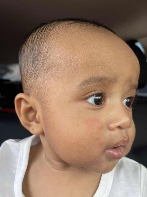 Tanda2 alergik tapi tak lama