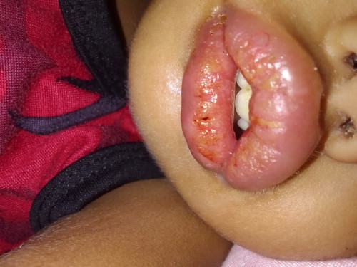 Mga mommy , ano po ba ang mabisang gamot po para gumaling ang Labi ni baby
