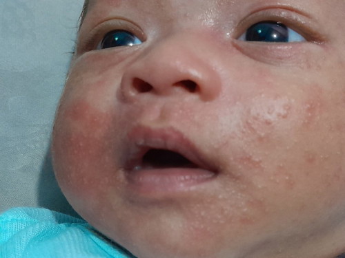 Bun anak saya pada ruam dimuka. Pakai produk apa ya yg kiranya cepet sembuh. kasian soalnya :(