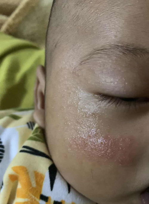 Bintik merah gatal di pipi