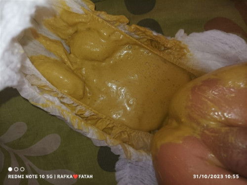 Fase normal atau tdk