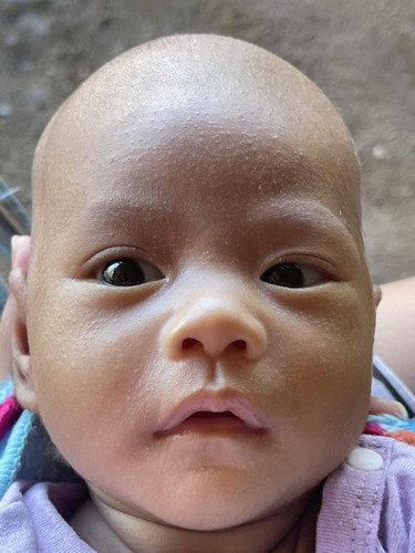ลูก1เดือน9วันมีผื่นเฉพาะหน้า