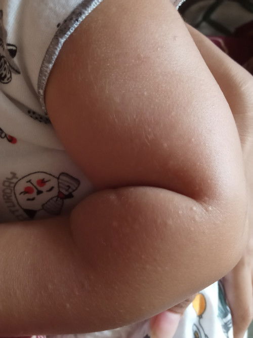 Bintik Putih Badan Bayi