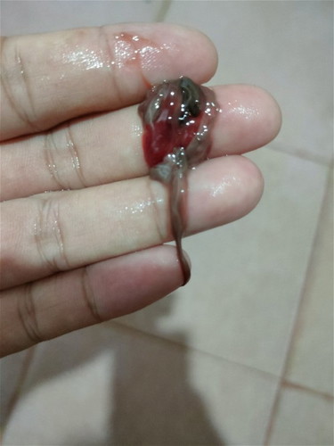 กระตุ้นปากมดลูกแล้วมีเลือดออกปกติไหม แม่ท้องแรก 39+1วัน