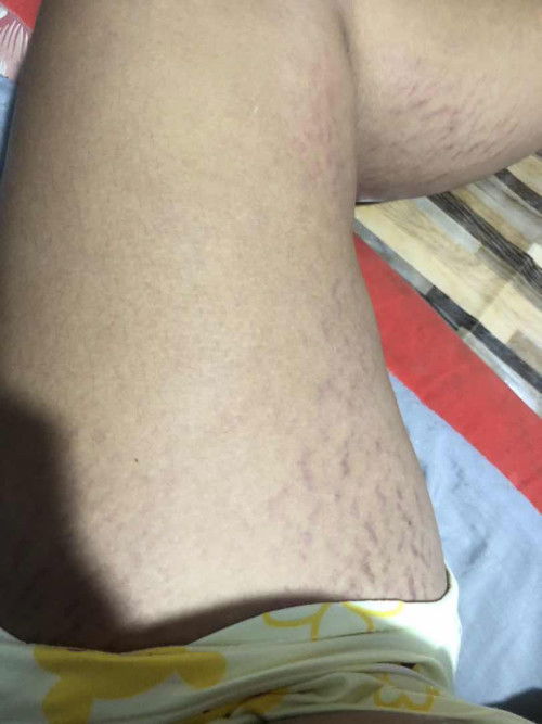 ท้องได้ 8เดือน แตกยับหมดเลย