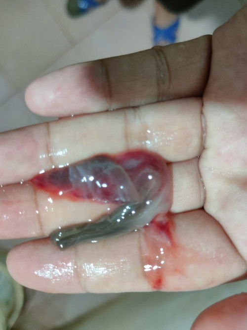 หมอกระตุ้นปากมดลูกแล้วเลือดออก แม่ท้อง39+1วันค่ะ