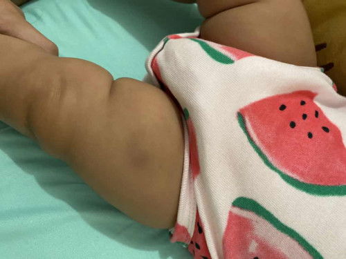 Kaki masih bengkak sudah 3 minggu setelah vaksin