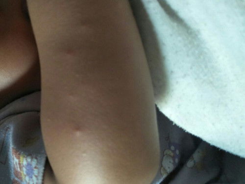 Bentol ditangan, dada, punggung