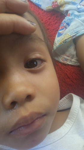 Ini apa ya yg ada di kelopak mata anak saya?? 😭