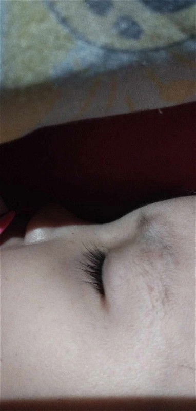 Pula pula sa paligid ng mata